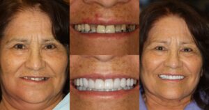 Before and after smile transformation — case 34, J. Ladd Williams Cosmetic Dentistry, Mesa AZ