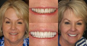 Before and after smile transformation — case 17, J. Ladd Williams Cosmetic Dentistry, Mesa AZ