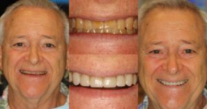 Before and after smile transformation — case 27, J. Ladd Williams Cosmetic Dentistry, Mesa AZ
