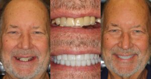 Before and after smile transformation — case 6, J. Ladd Williams Cosmetic Dentistry, Mesa AZ