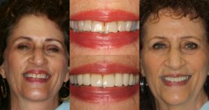 Before and after smile transformation — case 29, J. Ladd Williams Cosmetic Dentistry, Mesa AZ