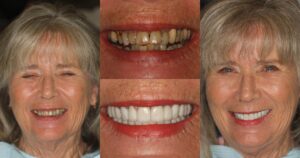 Before and after smile transformation — case 25, J. Ladd Williams Cosmetic Dentistry, Mesa AZ