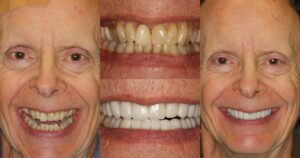 Before and after smile transformation — case 1, J. Ladd Williams Cosmetic Dentistry, Mesa AZ