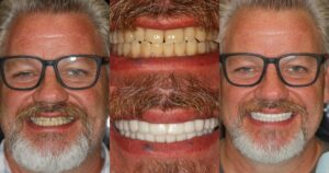 Before and after smile transformation — case 7, J. Ladd Williams Cosmetic Dentistry, Mesa AZ