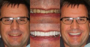 Before and after smile transformation — case 8, J. Ladd Williams Cosmetic Dentistry, Mesa AZ