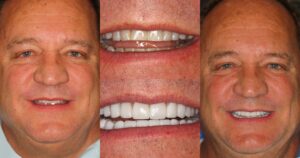 Before and after smile transformation — case 16, J. Ladd Williams Cosmetic Dentistry, Mesa AZ