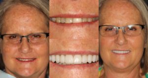 Before and after smile transformation — case 24, J. Ladd Williams Cosmetic Dentistry, Mesa AZ