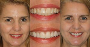 Before and after smile transformation — case 26, J. Ladd Williams Cosmetic Dentistry, Mesa AZ