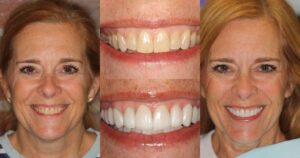 Before and after smile transformation — case 11, J. Ladd Williams Cosmetic Dentistry, Mesa AZ