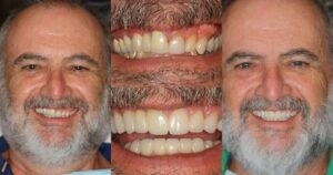 Before and after smile transformation — case 9, J. Ladd Williams Cosmetic Dentistry, Mesa AZ