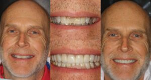 Before and after smile transformation — case 15, J. Ladd Williams Cosmetic Dentistry, Mesa AZ