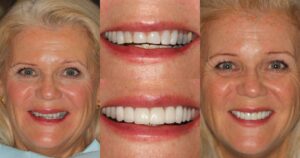 Before and after smile transformation — case 18, J. Ladd Williams Cosmetic Dentistry, Mesa AZ