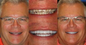 Before and after smile transformation — case 23, J. Ladd Williams Cosmetic Dentistry, Mesa AZ