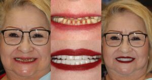 Before and after smile transformation — case 28, J. Ladd Williams Cosmetic Dentistry, Mesa AZ
