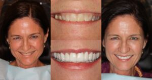 Before and after smile transformation — case 2, J. Ladd Williams Cosmetic Dentistry, Mesa AZ