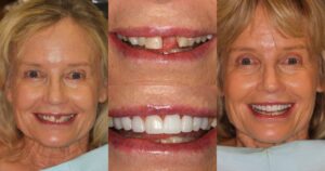 Before and after smile transformation — case 5, J. Ladd Williams Cosmetic Dentistry, Mesa AZ