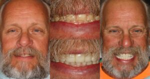Before and after smile transformation — case 10, J. Ladd Williams Cosmetic Dentistry, Mesa AZ
