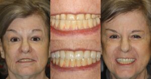 Before and after smile transformation — case 14, J. Ladd Williams Cosmetic Dentistry, Mesa AZ