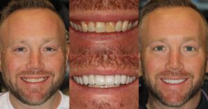 Before and after smile transformation — case 19, J. Ladd Williams Cosmetic Dentistry, Mesa AZ