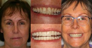 Before and after smile transformation — case 22, J. Ladd Williams Cosmetic Dentistry, Mesa AZ