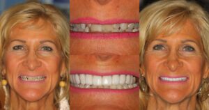 Before and after smile transformation — case 31, J. Ladd Williams Cosmetic Dentistry, Mesa AZ