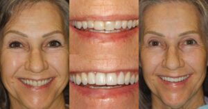 Before and after smile transformation — case 30, J. Ladd Williams Cosmetic Dentistry, Mesa AZ