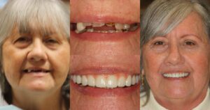Before and after smile transformation — case 3, J. Ladd Williams Cosmetic Dentistry, Mesa AZ