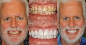 Before and after smile transformation — case 4, J. Ladd Williams Cosmetic Dentistry, Mesa AZ