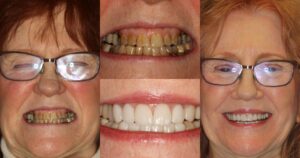 Before and after smile transformation — case 12, J. Ladd Williams Cosmetic Dentistry, Mesa AZ