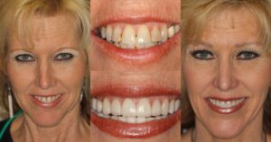Before and after smile transformation — case 13, J. Ladd Williams Cosmetic Dentistry, Mesa AZ