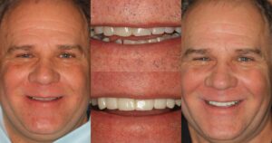 Before and after smile transformation — case 20, J. Ladd Williams Cosmetic Dentistry, Mesa AZ
