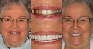Before and after smile transformation — case 21, J. Ladd Williams Cosmetic Dentistry, Mesa AZ