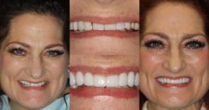 Before and after smile transformation — case 32, J. Ladd Williams Cosmetic Dentistry, Mesa AZ