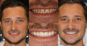 Before and after smile transformation — case 33, J. Ladd Williams Cosmetic Dentistry, Mesa AZ